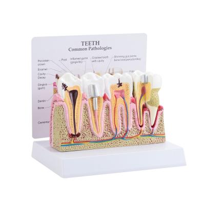 China CBM-002E hospitals common teeth pathologies model, human tooth model, education medical anatomical model for sale