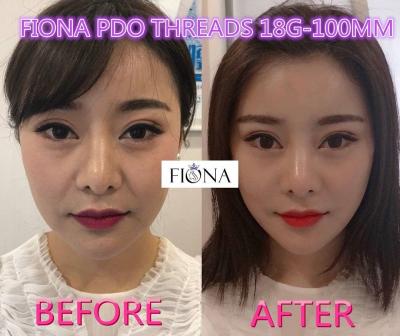 China Fiona PDO e hilo de PCL, hilo del lifting facial PDO de 38m m en venta