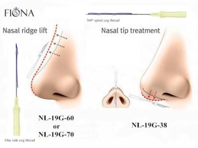 Chine Ascenseur de fil du nez PDO de Fiona Absorbable 60mm à vendre
