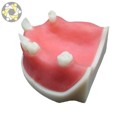 China Professional Cheap Education Implant Training Model For Missing Study Model Teeth Dental Base for sale