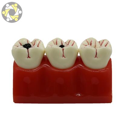 China Education Caries Demonstration Dilapidated Tooth Model Staged Model of Decay Tooth for sale