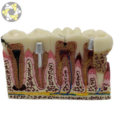 China Plastic Education Teeth Periodontal Human Medical Decay Common Pathologies Teeth Model for sale