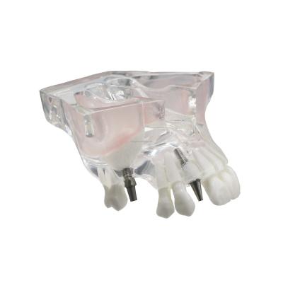 China Custom resin jaw typodont miscellaneous typodont dental implant model supply for sale