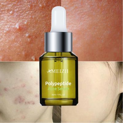 China Solution Natural Essence Anti-Puffiness Anti-Puffiness Peeling Care Repair Skin Serum OEM Polypeptide Acne Pimple Scar Remover Face Antibacterial Serum for sale