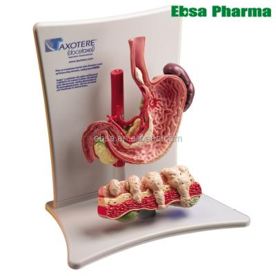 China PVC Advanced Human Teaching Supplies Stomach Cancer Model for sale