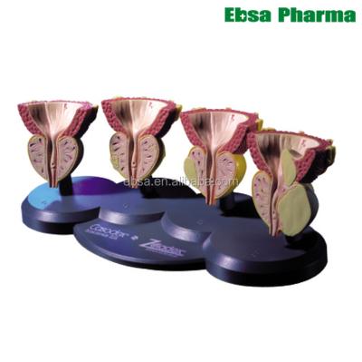 China PVC Prostate Cancer Model Human Four Stage For Pharmaceutical Company Gifts for sale