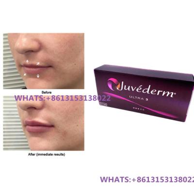 中国 Juvederm 唇用皮膚フィルラー Juvederm Ultra3 Ultra4 フィルラー 前注入注射器 販売のため