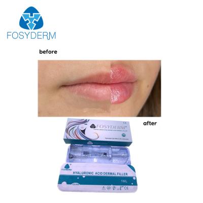 China Injeção ácida hialurónica cutânea dos enchimentos 1ml do bordo de Fosyderm para o realce do bordo à venda