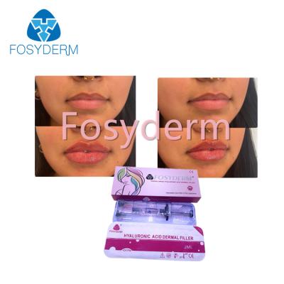 China Hyaluronic Zure Huidvuller van Injectiefosyderm voor Verbonden Lippen2ml Dwars Te koop