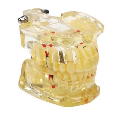 China Not Easy To Broken Dental Plastic Removable Anatomy Model Oral Model Study Demonstration Model for sale