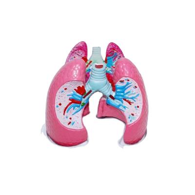 China PVC Quality Assurance Medical Model Supplies PVC Material Anatomical Model Of Lung Disease for sale