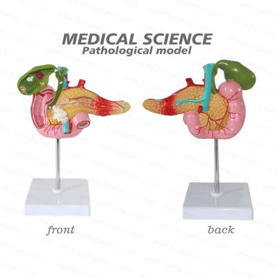 China Learning resources medical body learning resaurce natural size human anatomical model duodenum, pancreas and gallbladder pathological model for sale