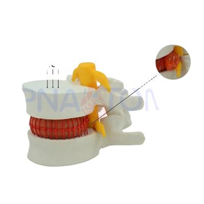 China Advanced PVC Enlarged Lumbar Vertebra New Model Design Human Skeletal Model for sale