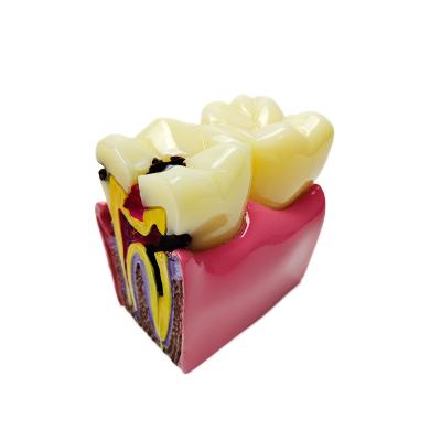 China Resin comparison of tooth decay morphology and healthy morphology for sale