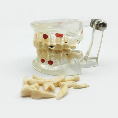 China Detailed Anatomy Structures Dental Pathology Model Doctor-Patient Communication Demonstration Model Implant Tooth Decay Wisdom Teeth for sale