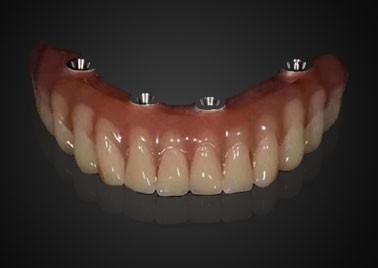 China Customized Replacing Dental Implant Crown Wear Resistant For Long Term Use for sale