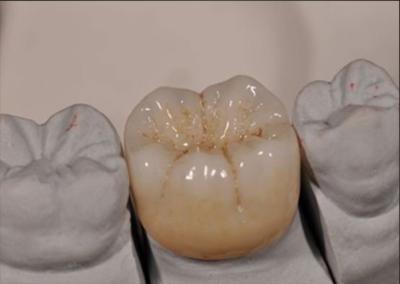 Chine Haut esthétique Noritake Zirconia couleur naturelle stable pour la couronne complète de zirconia à vendre