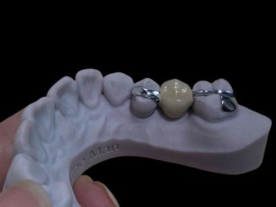 China Dentário de ponta de Maryland de longa duração, personalizável para restauração. à venda