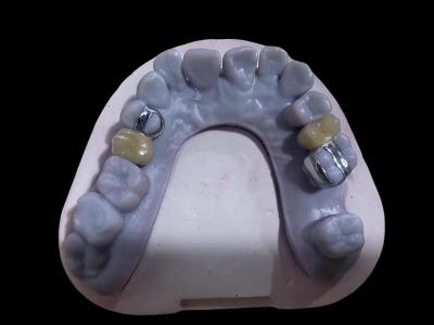 China Coronas de porcelana de metal libre de aleación dental de corona PFM de alta precisión en venta