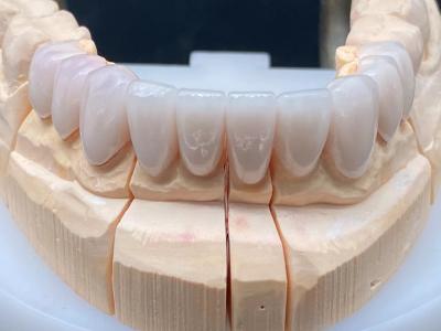 China Laboratorio Dental E Max Corona cerámica de alta transparencia con resistencia a la corrosión en venta