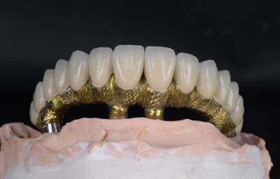 China Implantes e coroas dentárias de liga de titânio de aparência natural e resistentes à corrosão à venda