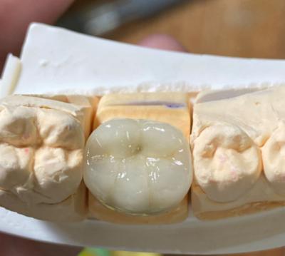 Cina Precise estetica forte dentale PFM porcellana fusa a corona di metallo in odontoiatria in vendita