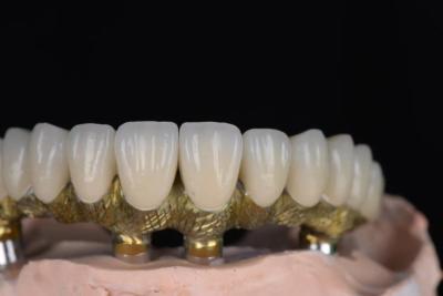 Cina Corone di porcellana naturale fusa in metallo ad alta precisione per impianti dentali in vendita