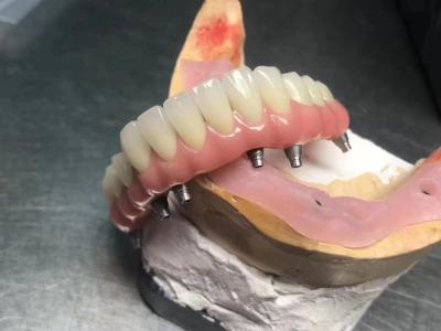 China Implante sólido de alta translucidez con corona de apoyo personalizable para la restauración dental en venta