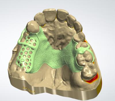 중국 디지털 금속 프레임 CAD CAM 치과 디자인 3D 프린팅과 함께 코크 재료 판매용