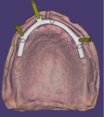 China Personalisiertes CAD-CAM-Dentaldesign mit hoher Präzision für Implantatgestützte Stange zu verkaufen