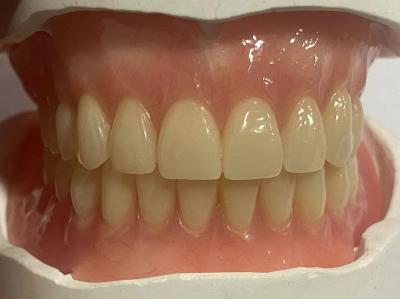 China Dentadura parcial extraíble hipoalergénica personalizada con color rosado de goma en venta