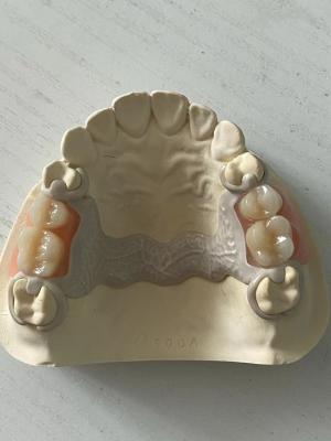 China Dental PEEK de acrílico parcial personalizado Dentadura ajustable con ajuste seguro en venta