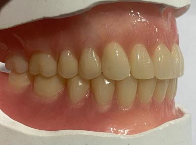 China Customized Natural Looking Full Denture Acrylic Teeth For Optimal Retention for sale