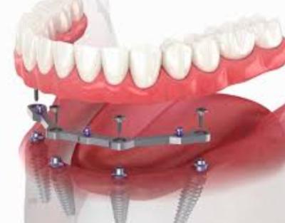 China Barras dentales de titanio fresadas de arco completo de 12 mm de longitud con más de 2 accesorios en venta