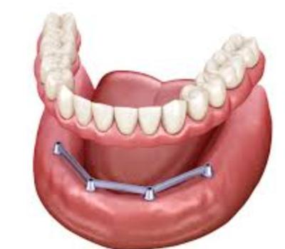 China Barras de implante translúcidas retidas por parafuso Dentadura de superfície polida Barras de implante à venda