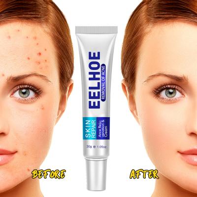 China Skin Revitalizer Cream For Acne Treatment 30g Acne Cream Anti Acne Cream for sale