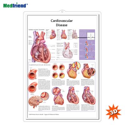 China PVC Material Authorized Educational Plastic Medical Anatomical Chart /Poster - 3D Wall Cardiovascular Disease for sale