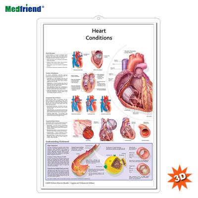 China PVC Material Authorized Educational Plastic Medical Anatomical Chart /Poster - 3D Wall 3D Heart Diseases for sale