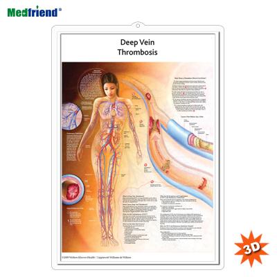 China PVC Material Authorized Educational Plastic Medical Anatomical Chart /Poster - Deep Vein Wall 3D Thrombosis DVT for sale