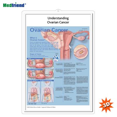 China PVC Material Authorized Educational Plastic Medical Anatomical Chart /Poster - 3D Wall Understanding Ovarian Cancer for sale