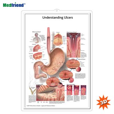 China PVC Material Authorized Educational Plastic Medical Anatomical Chart /Poster - 3D Wall Understanding Ulcers for sale