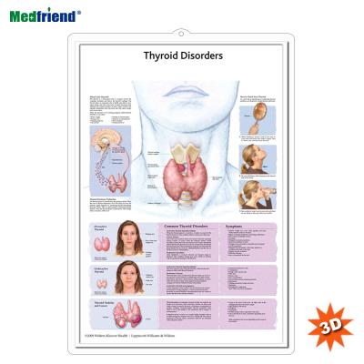 China PVC Material Licensed Educational Plastic Medical Anatomical Chart /Poster - 3D Wall Thyroid Disorders for sale