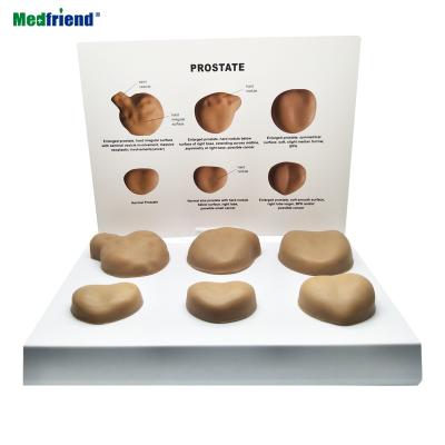 China Patients Care Demonstration Factory Price Anatomical Human Prostate Disease Progressive Set Of 6 Anatomical Models for sale