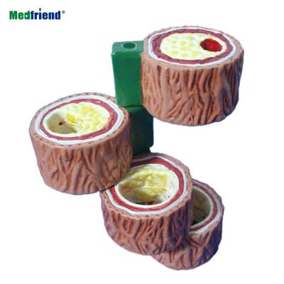 China Patients Care Demonstration Four-piece Artery Model Artery Model Progressive Set Cholesterol Atherosclerosis for sale