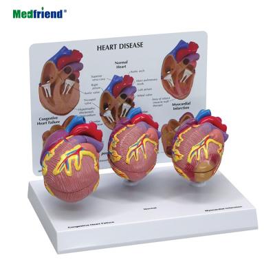 China Patients Care Demonstration 3 Pcs Mini Heart Anatomical Model Mini Sick Heart Set Model for sale