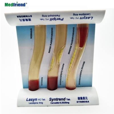 China Patients Care Demonstration Vessel Liquid Human Atherosclerosis Vascular Model Diseased Artery Model for sale