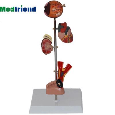 China Patients Care Demonstration Mini Diabetes Type 2 Anatomical Organ Model Set Eye, Heart, Kidney, Artery, Foot for sale