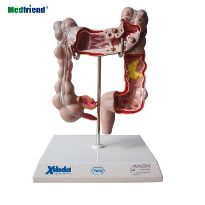 China Patients care demonstration model of familiar diseases of the colon and rectum for sale