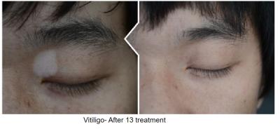 China Uso da casa do Vitiligo do deleite do sistema do laser do Excimer da lâmpada 308NM de XeCl à venda