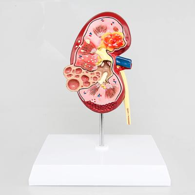 China Kidney Urinary Tract Stones Kidney Model Kidney Medical Renal Anatomical Model Disease School Hospital Model for sale